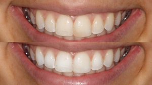 Whitening