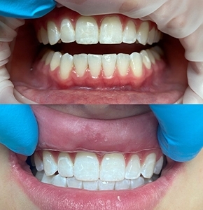 Whitening