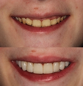 Smile Makeover